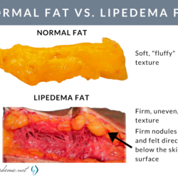 Do i have lipedema quiz