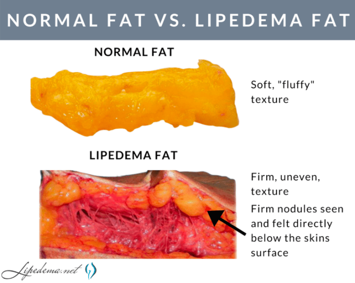 Do i have lipedema quiz